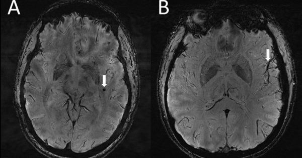 Psychische Erkrankung Im Mrt Sichtbar MRT-Bilder zeigen:: So sieht Migräne im Gehirn aus - News - MedicalDesign